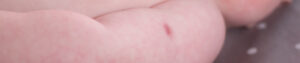 Bebê com marca de vacina no braço