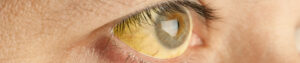 Pessoa com olhos amarelados